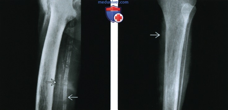 Рентгенограмма, КТ, МРТ костей при гиперпаратиреозе