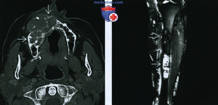 Рентгенограмма, КТ, МРТ костей при гиперпаратиреозе