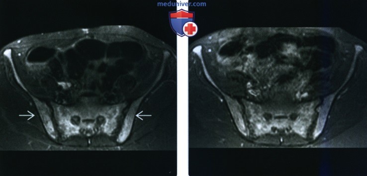 Рентгенограмма, КТ, МРТ при костных проявлениях лейкемии