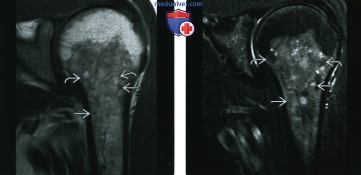 Рентгенограмма, КТ, МРТ костей при саркоидозе