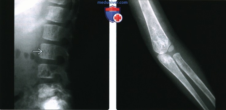 Рентгенограмма, КТ, МРТ костей при талассемии