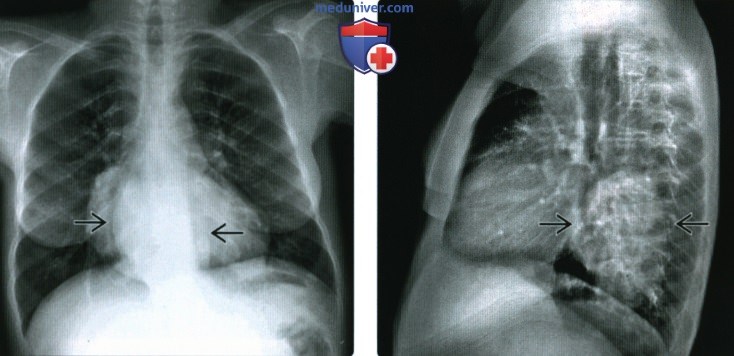 Рентгенограмма, КТ, МРТ костей при талассемии