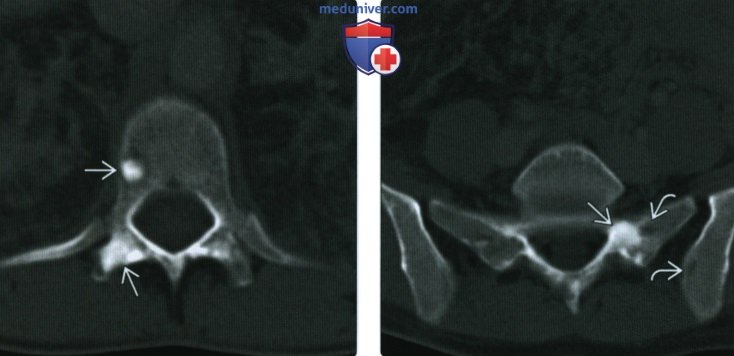 Рентгенограмма, КТ, МРТ костей при туберозном склерозе