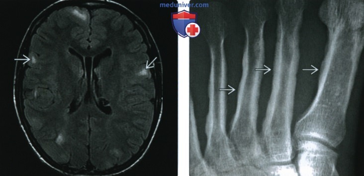 Рентгенограмма, КТ, МРТ костей при туберозном склерозе