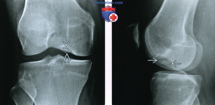 Рентгенограмма, КТ, МРТ при костно-хрящевой травме коленного сустава