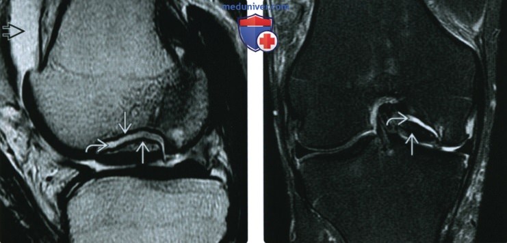 Рентгенограмма, КТ, МРТ при костно-хрящевой травме коленного сустава