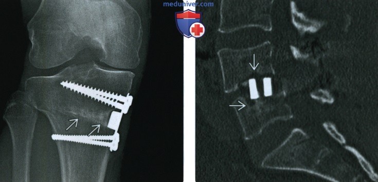 Рентгенограмма, КТ, МРТ при костном цементе и заменителе костной ткани
