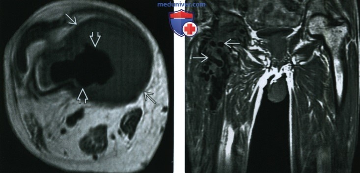 Рентгенограмма, КТ, МРТ при костном цементе и заменителе костной ткани