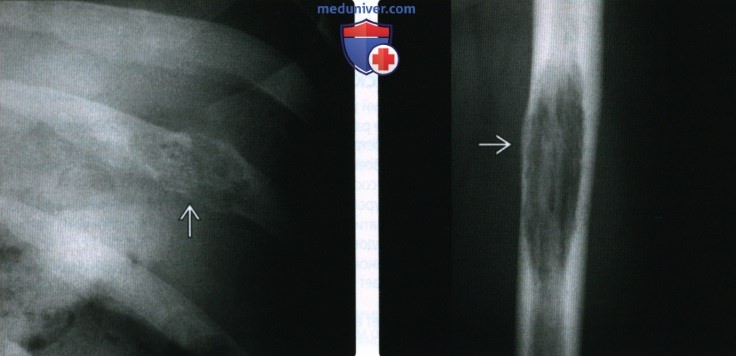 Рентгенограмма, КТ, МРТ при костной ангиосаркоме