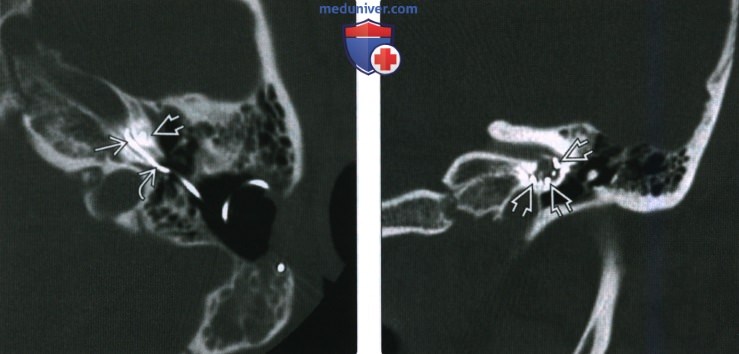 Рентгенограмма, КТ, МРТ при кохлеарном импланте (КИ)