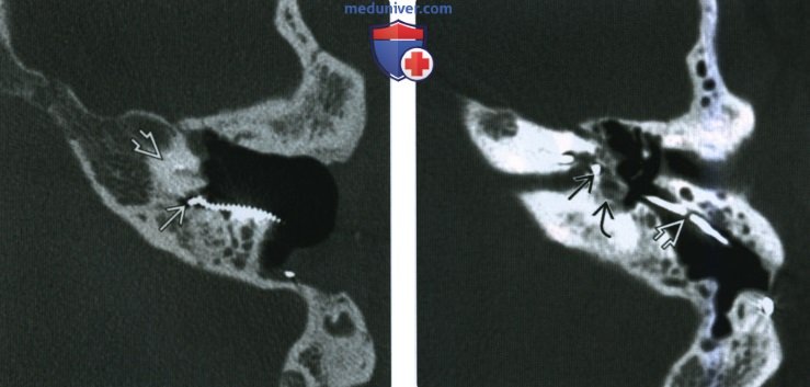 Рентгенограмма, КТ, МРТ при кохлеарном импланте (КИ)