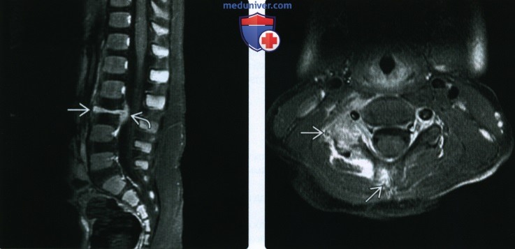 Рентгенограмма, КТ, МРТ при лангергансоклеточном гистиоцитозе