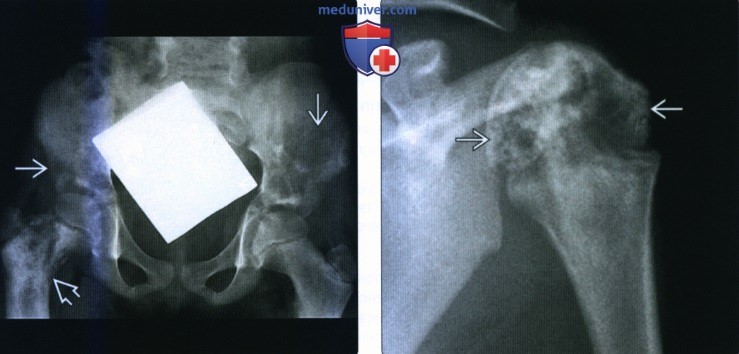 Рентгенограмма, КТ, МРТ при лимфоме кости