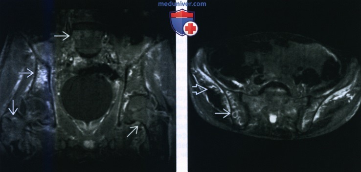Рентгенограмма, КТ, МРТ при лимфоме кости