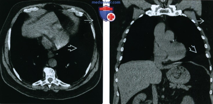Рентгенограмма, КТ, МРТ при липоматозе мягких тканей