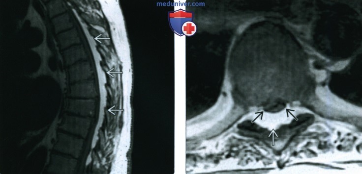 Рентгенограмма, КТ, МРТ при липоматозе мягких тканей
