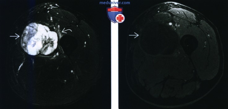 Рентгенограмма, КТ, МРТ при миксофибросаркоме