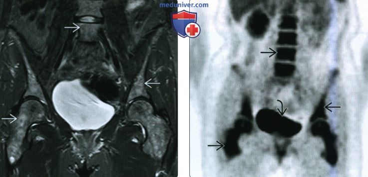 Рентгенограмма, КТ, МРТ при множественной миеломе
