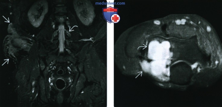 Рентгенограмма, КТ, МРТ при нейрофиброматозе