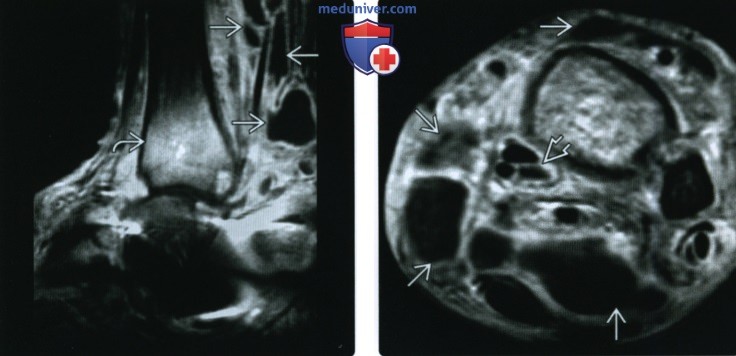 Рентгенограмма, КТ, МРТ при нейропатической остеоартропатии (Шарко)