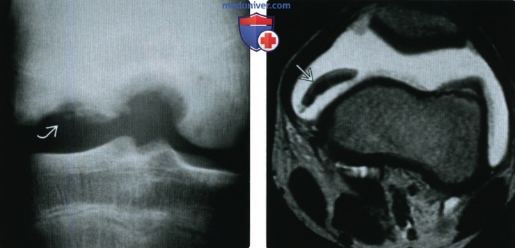 Рентгенограмма, КТ, МРТ при нейропатической остеоартропатии (Шарко)