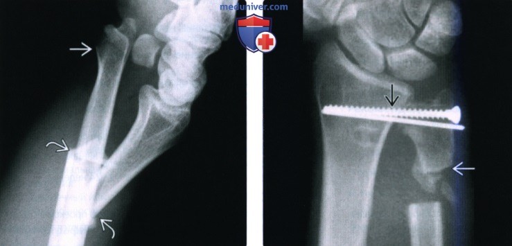 Рентгенограмма, КТ, МРТ при нестабильности дистального лучелоктевого сустава