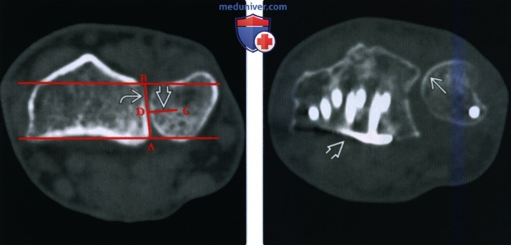 Рентгенограмма, КТ, МРТ при нестабильности дистального лучелоктевого сустава