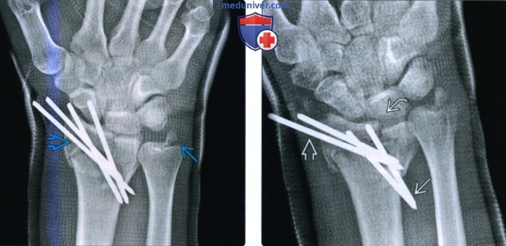 Рентгенограмма, КТ, МРТ после операции по поводу перелома луча в типичном месте