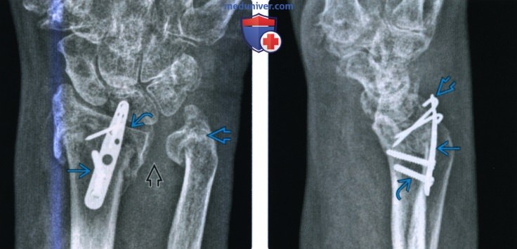 Рентгенограмма, КТ, МРТ после операции по поводу перелома луча в типичном месте
