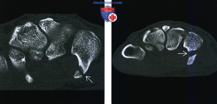 Рентгенограмма, КТ, МРТ после операции по поводу перелома ладьевидной кости