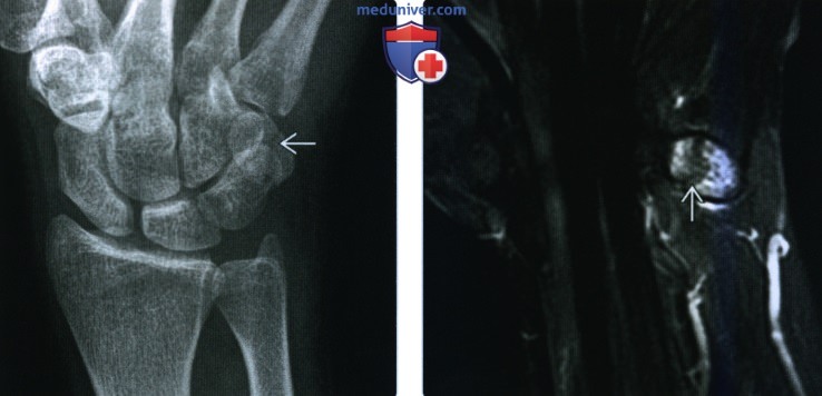 Рентгенограмма, КТ, МРТ после операции по поводу перелома ладьевидной кости