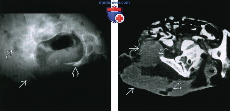 Рентгенограмма, КТ, МРТ при скелетных и мышечных осложнениях параплегии