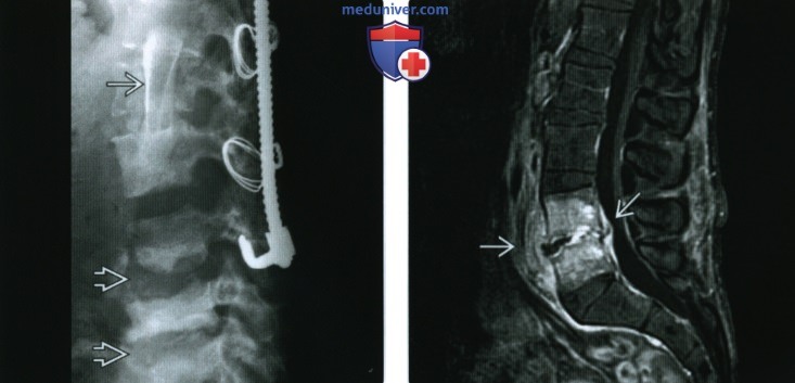 Рентгенограмма, КТ, МРТ при скелетных и мышечных осложнениях параплегии