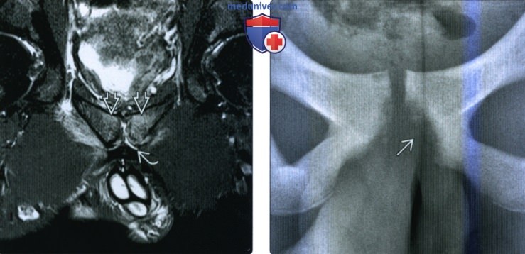 Рентгенограмма, КТ, МРТ остеита лобковой кости