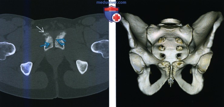 Рентгенограмма, КТ, МРТ остеита лобковой кости
