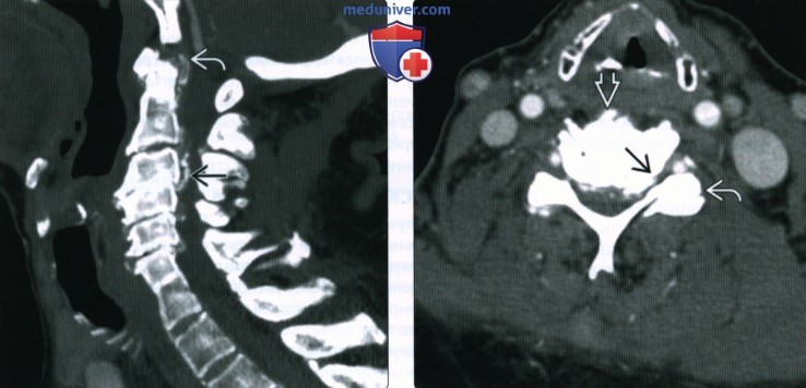 Рентгенограмма, КТ, МРТ при остеоартрозе осевого скелета