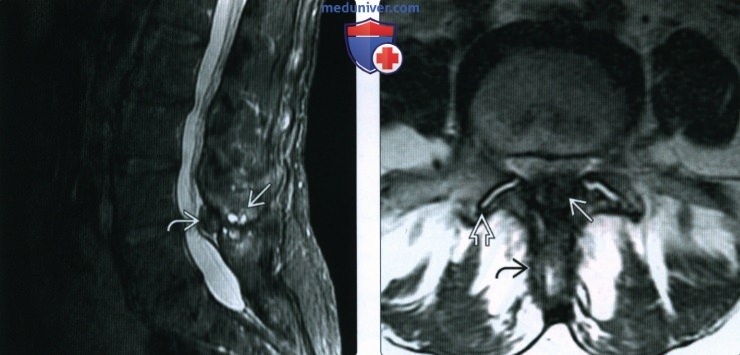 Рентгенограмма, КТ, МРТ при остеоартрозе осевого скелета