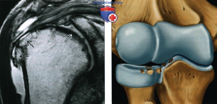 Рентгенограмма, КТ, МРТ при остеоартрозе плечевого и локтевого суставов