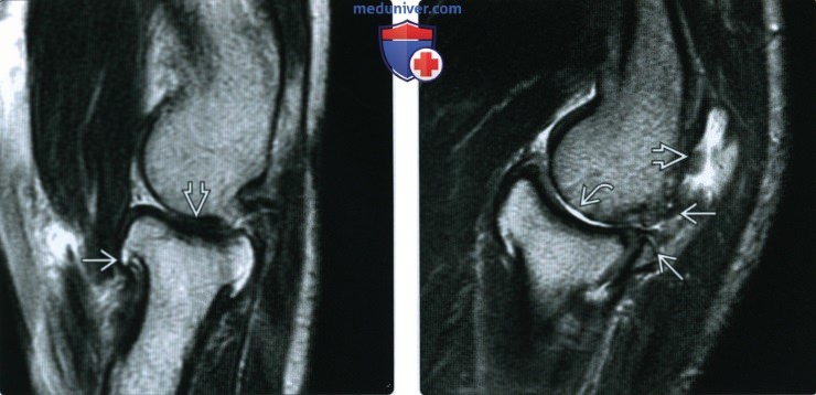 Рентгенограмма, КТ, МРТ при остеоартрозе плечевого и локтевого суставов