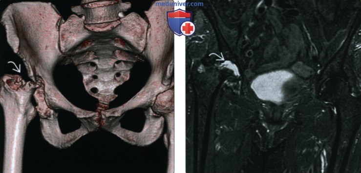 Рентгенограмма, КТ, МРТ при остеоартрозе тазобедренного сустава