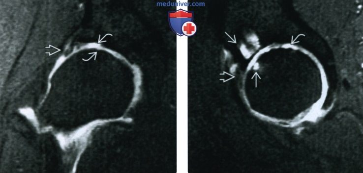 Рентгенограмма, КТ, МРТ при остеоартрозе тазобедренного сустава