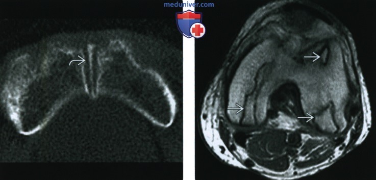 Рентгенограмма, КТ, МРТ при почечной остеодистрофии