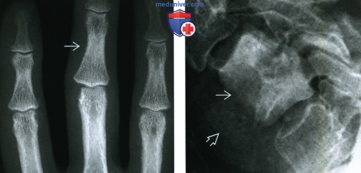 Рентгенограмма, КТ, МРТ при почечной остеодистрофии
