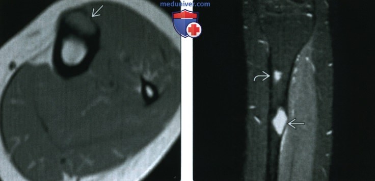 Рентгенограмма, КТ, МРТ при остеофиброзной дисплазии