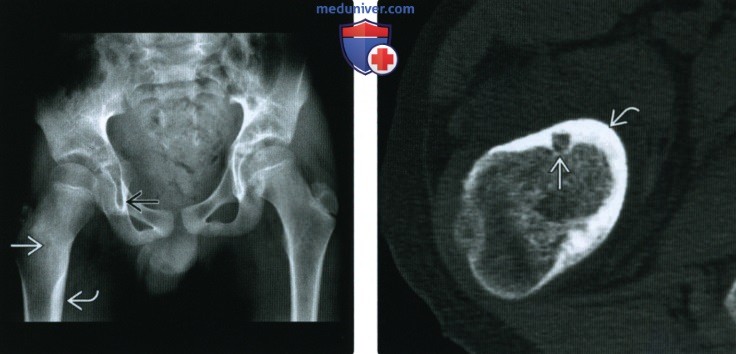 Рентгенограмма, КТ, МРТ при остеоид-остеоме