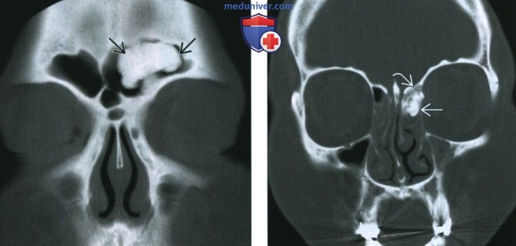 Рентгенограмма, КТ, МРТ при остеоме