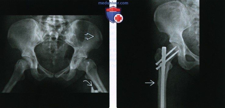 Рентгенограмма, КТ, МРТ при остеопетрозе