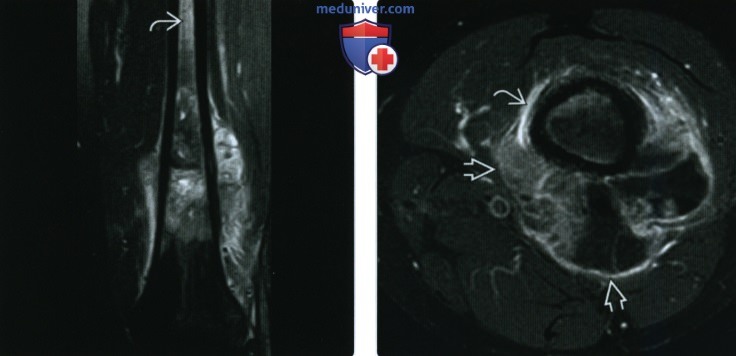 Рентгенограмма, КТ, МРТ при обычной остеосаркоме