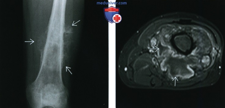 Рентгенограмма, КТ, МРТ при обычной остеосаркоме