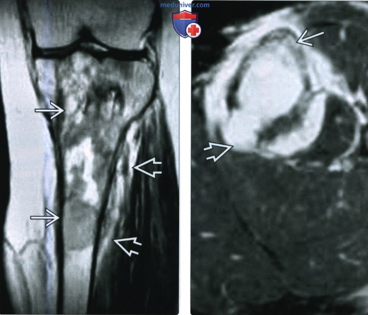 Рентгенограмма, КТ, МРТ при внутрикостной остеосаркоме низкой степени злокачественности